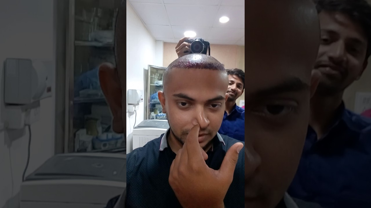 Fue Hair Transplant Result After 5 Months Darling Roots By