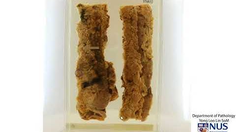 Colon: Ulcerative Colitis Gross Features