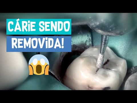 Vídeo: Tratamentos De Cárie Para Cães - Tratamentos De Cárie Para Cães