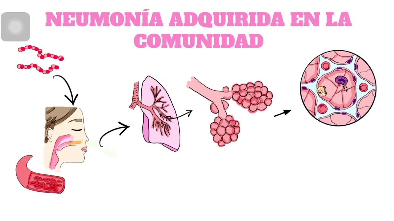 Fisiopatologia De La Neumonia Adquirida En La Comunidad