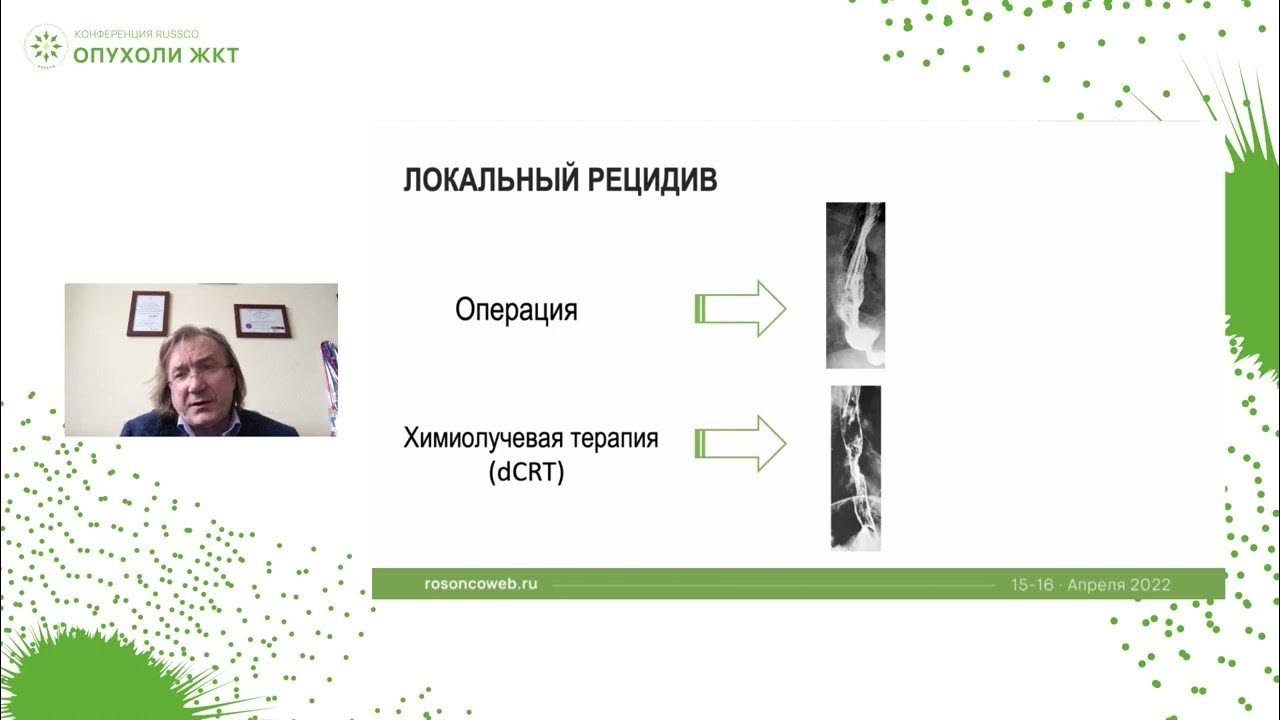 Рецидив рака после операции