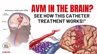 Brain AVM Treatment Without Surgery | How Catheter Therapy Works!