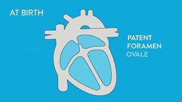 Patent Foramen Ovale Closure   Amplatzer PFO Occluder