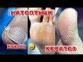 ОГРОМНЫЕ  НАТОПТЫШИ 😮 ПОДНОГТЕВАЯ МОЗОЛЬ 😮КЕРАТОЗ 💅 Педикюр на возрастных ногах