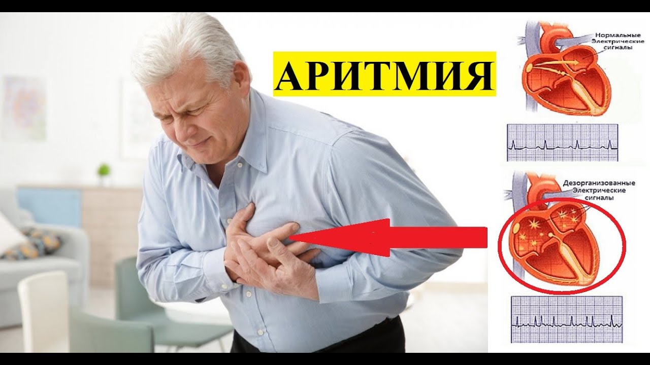 ЮРАК АРИТМИЯСИ   АРИТМИЯНИ ДАВОЛАШ