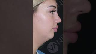Define Your Jawline With Jowl Liposuction! #JowlLiposuction #DoubleChin