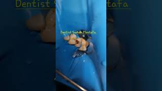 Is it coronal perforation  endodontic treatment dentist