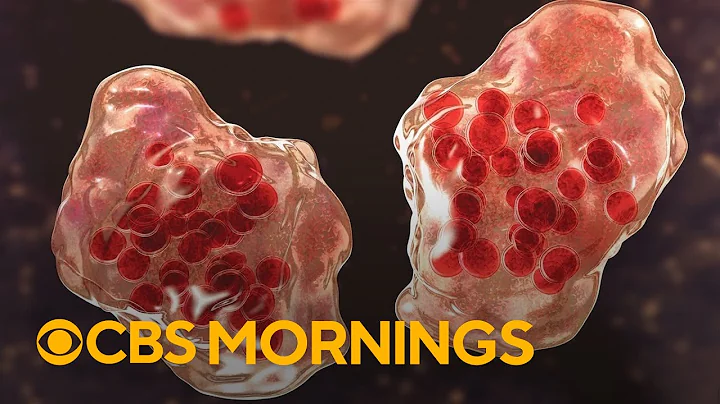 What to know as measles cases in U.S. hit highest level recorded in over 30 years