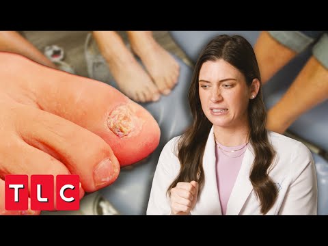 Fungus Runs in the Family: Dr. Sarah Treats 3 Sisters with Foot Fungus | My Feet Are Killing Me