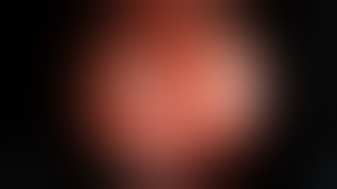 Cholangiocarcinoma -- Bismuth Type IV