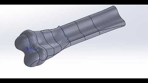 cad model of Human femur thigh bone by Solidworks for human  total knee replacement tkr