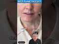 Deep Plane Facelift (Before & After) #results #plasticsurgery #beforeandafter #facelift #fyp