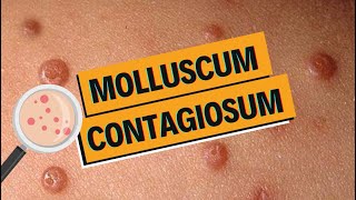 Molluscum contagiosum : comment les soigner ? screenshot 4