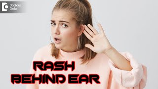 Rash Behind Ear: Know Why??? |  Symptoms & Treatment - Dr. Rasya Dixit | Doctors' Circle