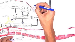 Burns Detailed Overview - Types Pathophysiology Tbsa