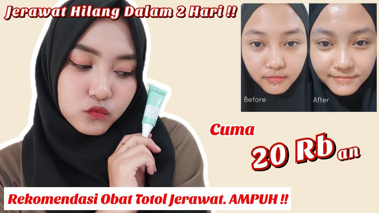 obat jerawat paling ampuh, acne spot gel, acne spot treatment, acne gel spo...