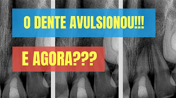 O que fazer em caso de avulsão de dente?