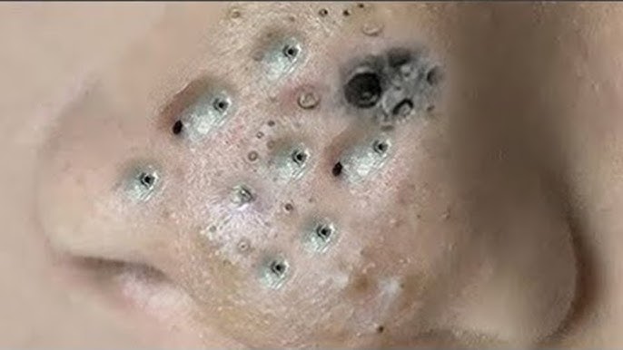 Big Cystic Acne Blackheads Extraction Blackheads & Milia, Whiteheads  Removal Pimple Popping # 3930 - YouTube