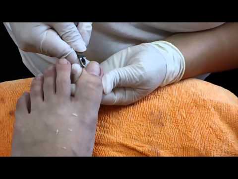 Ingrown Toenail Removal [HD]