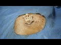 Soft Skin Healing โ Relaxing Pimple Extraction Experience