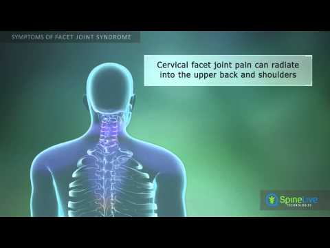 Facet Joint Syndrome