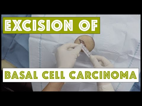 Excision of a basal cell carcinoma on the thigh, wearing my GoPro!