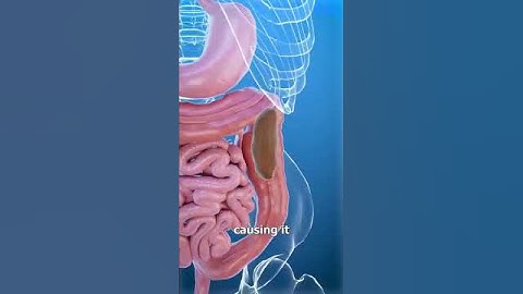 🚨 Understanding Constipation: A Closer Look at the Colon 🚨 #anatomy