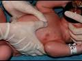 Diagnostic de la détresse fœtale avant la naissance
