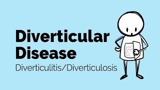 Featured image of post Symptoms Of Diverticulitis Flare Up - Sign up for the best tips to take care of your stomach.