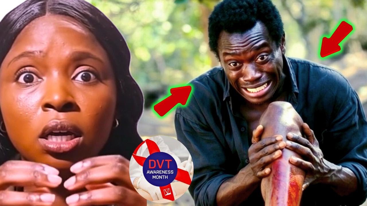 Deep Vein Thrombosis How to Prevent DVT: Doctor-Recommended Tips