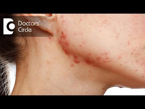 What causes acne scarring, keloids and recurring cysts on body? - Dr. Tina Ramachander