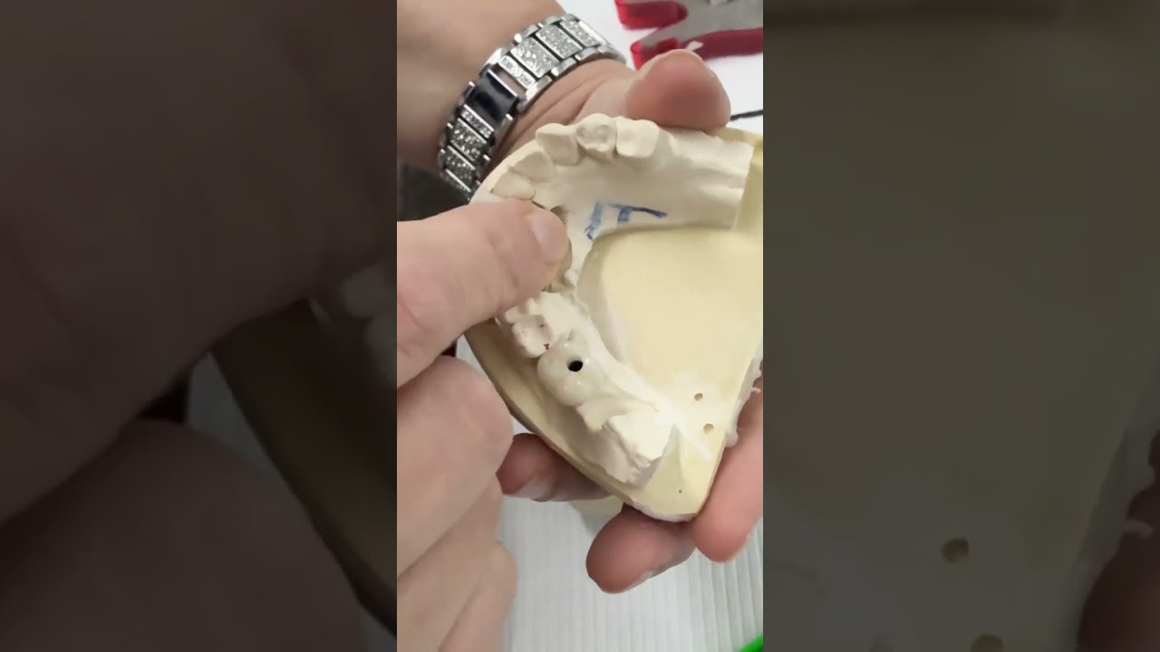 Part 1 of Replacing Missing Teeth!!  #trusteddentist #dentist