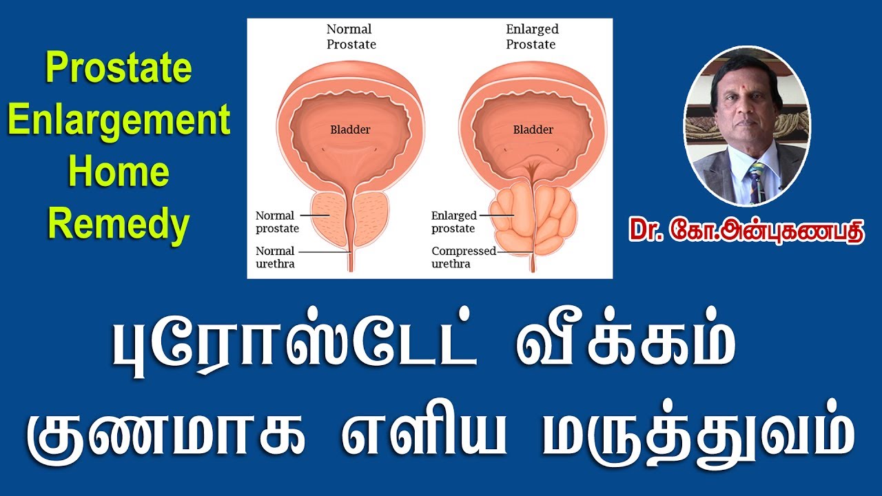 Prostate enlargement home remedy in tamil
