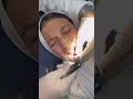 خلع ناب لبني اسفله ناب دائم