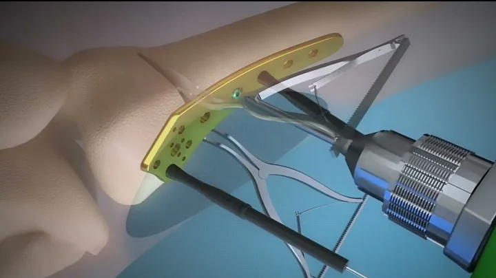 Distal Femoral Osteotomy Animation