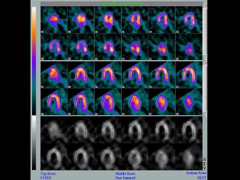 Gammagrama SPECT Cardiaco
