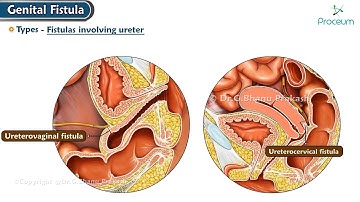 Genital Fistula: Types, clinical features, Diagnosis, Management