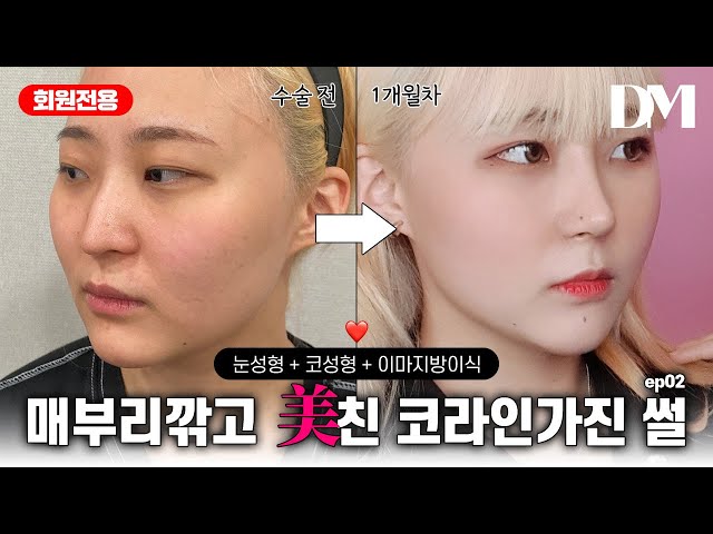 무쌍에 매부리코에서 ♡귀염녀♡로 변한 썰 풀어본다!!               #쌍꺼풀 #뒤밑트임 #코성형 #이마지방이식 #매부리