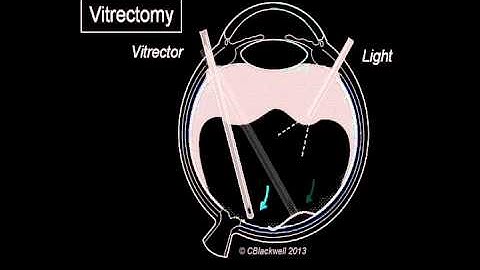 Vitreous 3: Vitrectomy Surgery