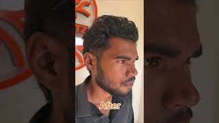 Grade 4 Baldness Hair Transplant After 1 Year 😍🔥 Patient Results #Shorts