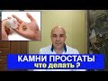 Камни предстательной железы Что делать?