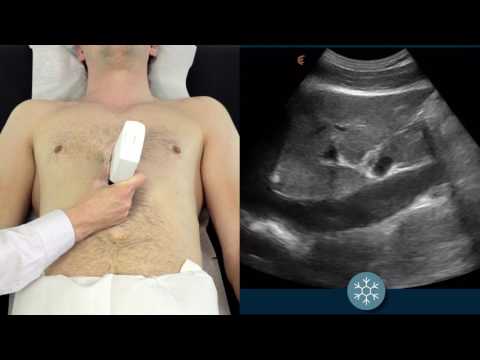 IVC Ultrasound | How to assess the IVC for volume status using ultrasound | Clarius Ultrasound