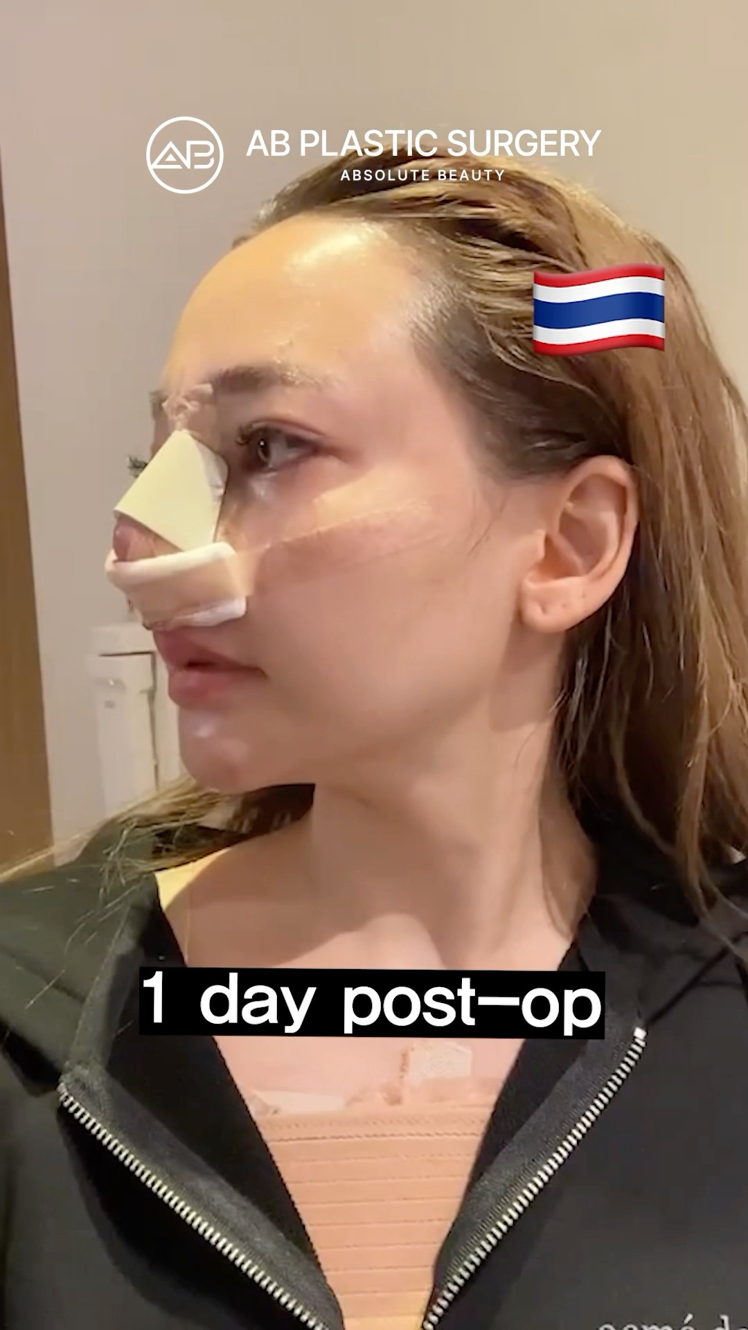 What Happens After a Nose Job? You Won’t Believe Day 7! #koreanplasticsurgery