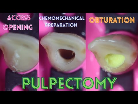 Access Opening ⚪️ Chemomechanical Preparation 🟢 Obturation 🟡 Pulpectomy 🟠 Primary Central Incisor