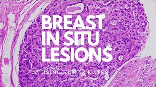Breast In Situ Lesions: Kurt’s Notes #pathagonia
