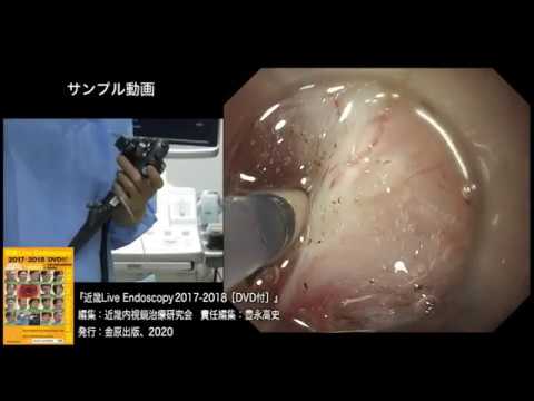 近畿 Live Endoscopy 2017-2018［DVD付］【サンプル動画】 - YouTube