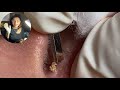 Acne Treatment Huong Da Nang | 589 | Acne in Ears