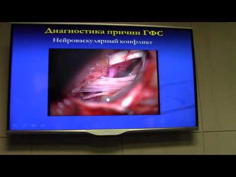 нейроваскулярный конфликт 1