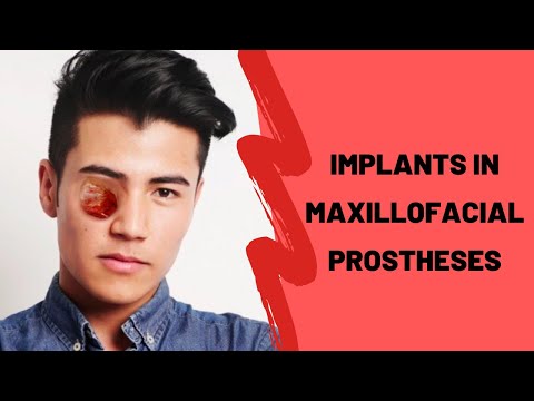 Implants in Maxillofacial