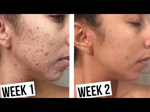 How To Clear Acne In  Weeks! Makari De Suisse Skincare!  BiancaReneeToday